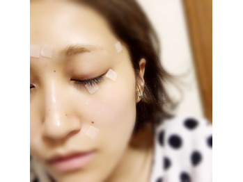 コリと美容に！！円皮鍼☆美容鍼_20170514_2